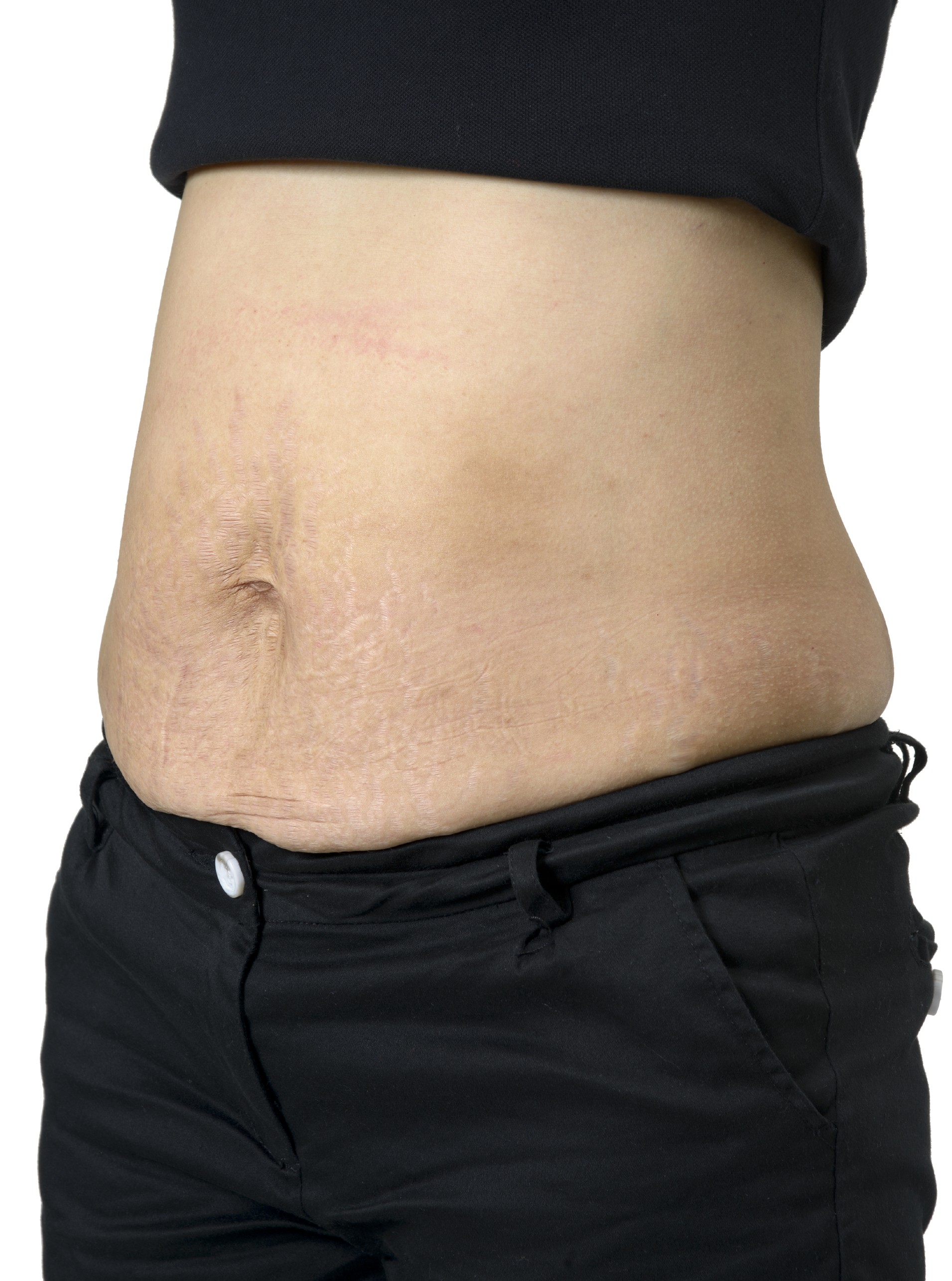 How Do You Tighten Loose Skin After Weight Loss 