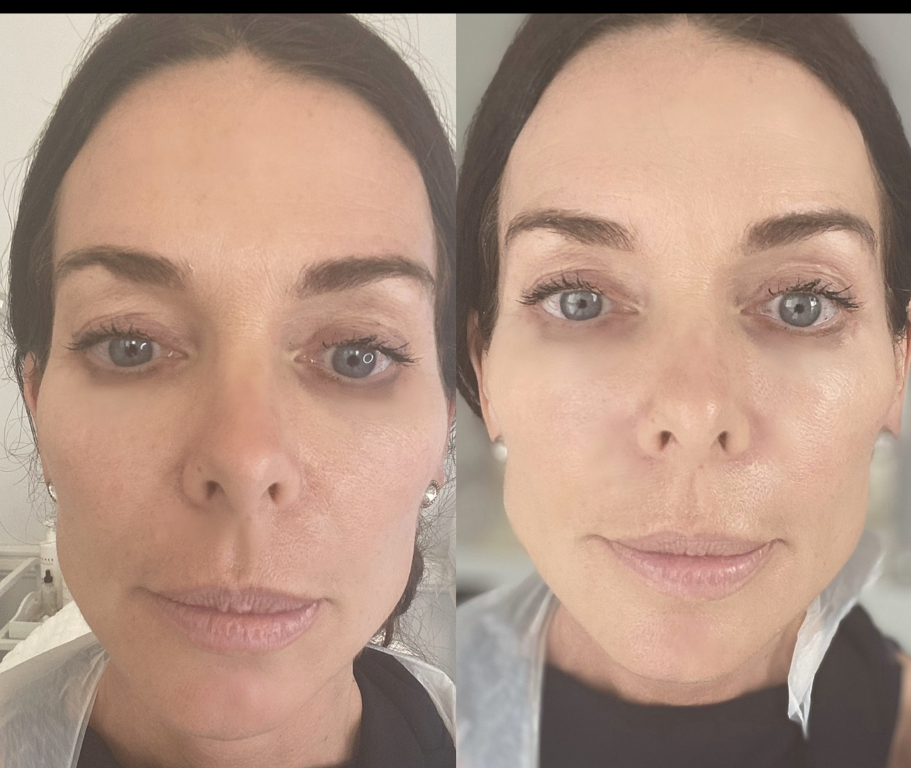 Before And After Profhilo Before And After Profhilo
